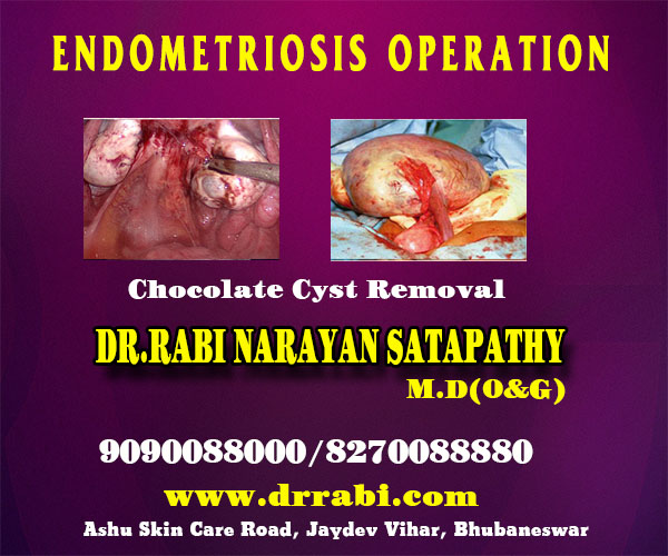 best endometriosis operation clinic in bhubaneswar near me